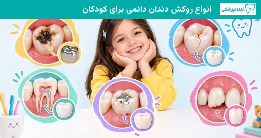 انواع روکش دندان دائمی برای کودکان