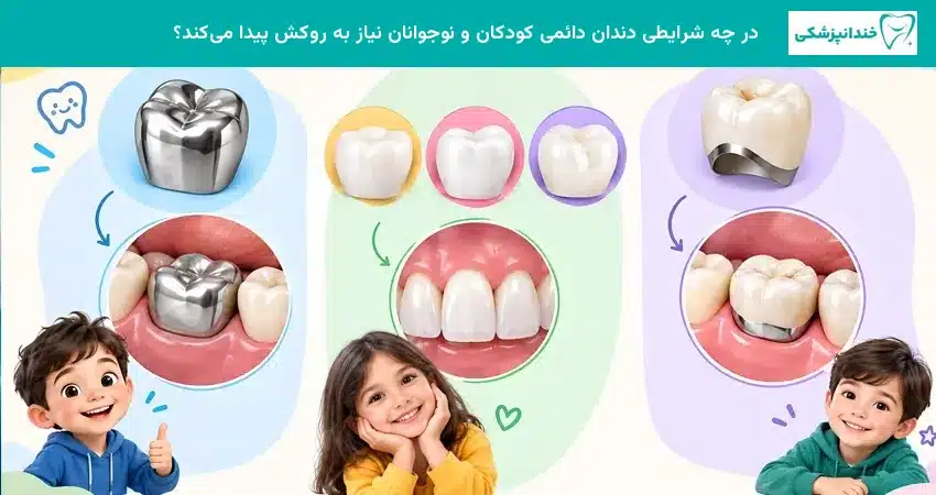 در چه شرایطی دندان دائمی کودکان و نوجوانان نیاز به روکش پیدا میکند؟