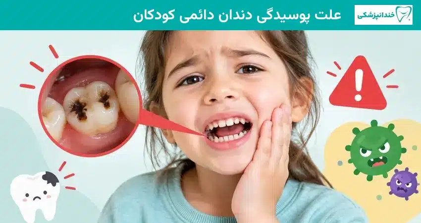 علت پوسیدگی دندان دائمی کودکان