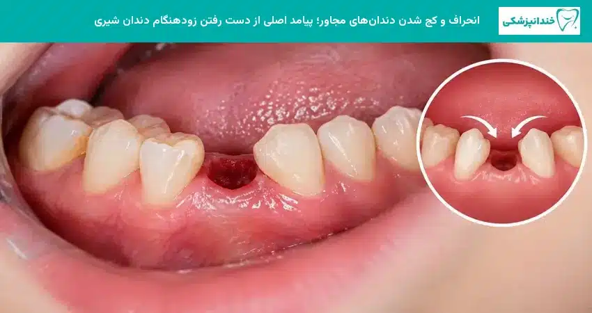 انحراف و کج شدن دندانهای مجاور؛ پیامد اصلی از دست رفتن زودهنگام دندان شیری