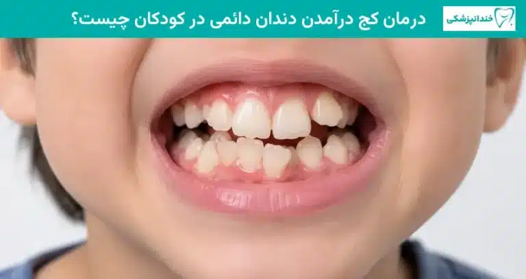 درمان کج درآمدن دندان دائمی در کودکان چیست؟