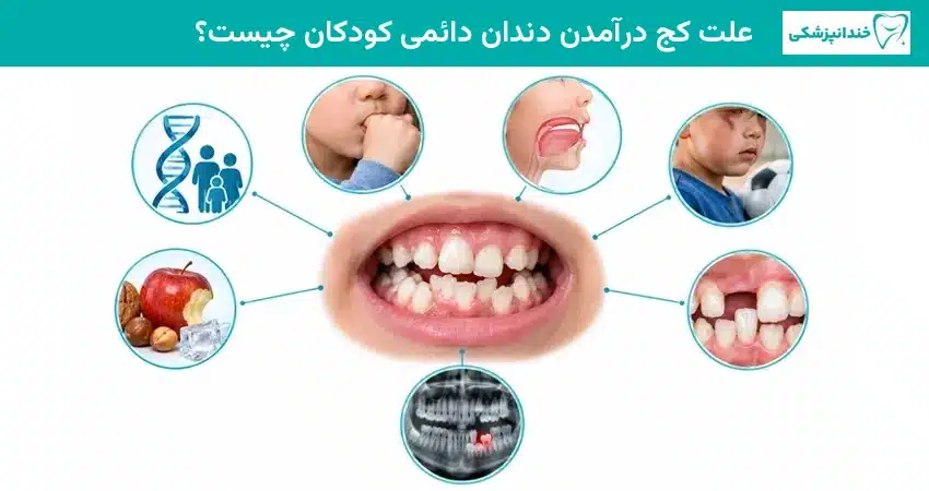 علت کج درآمدن دندان دائمی کودکان چیست؟