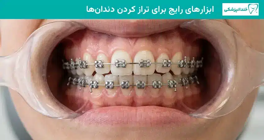 ابزارهای رایج برای تراز کردن دندان ها
