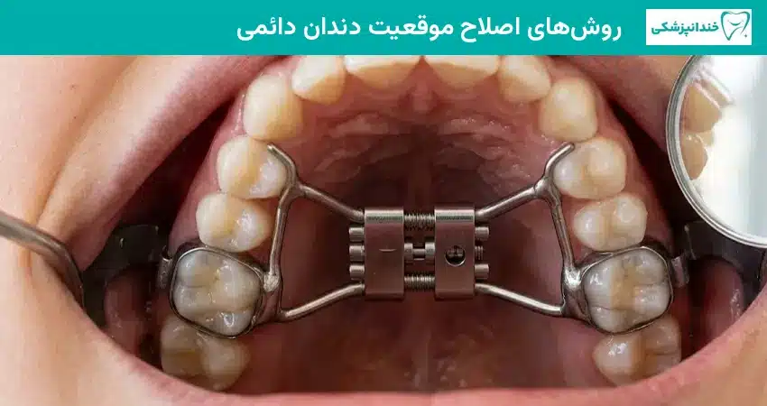 روش های اصلاح موقعیت دندان دائمی