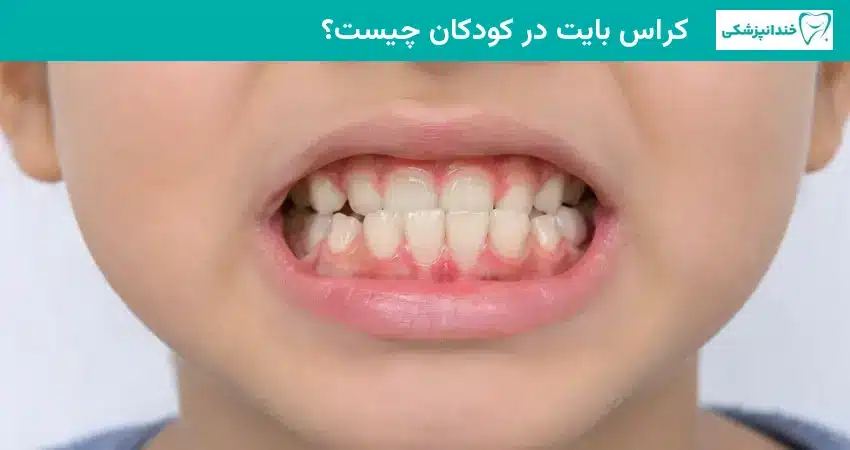 کراس بایت در کودکان چیست؟