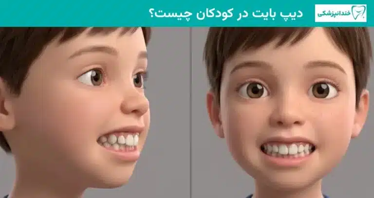 دیپ بایت در کودکان چیست؟