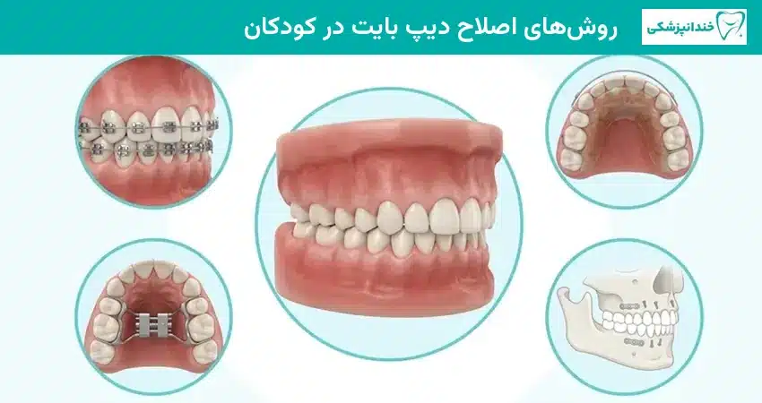 روشهای اصلاح دیپ بایت در کودکان