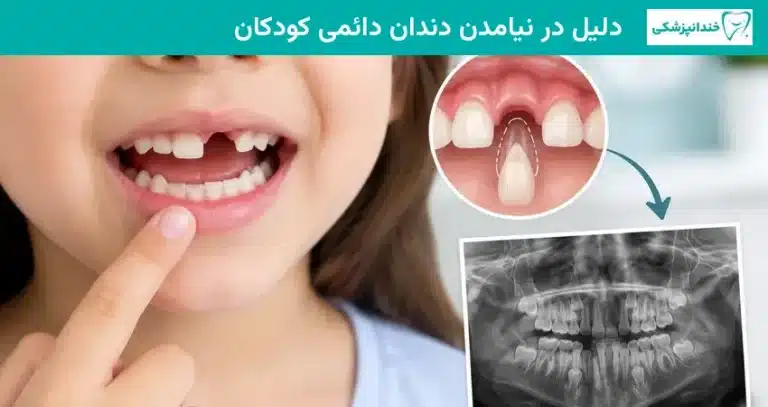دلیل در نیامدن دندان دائمی کودکان