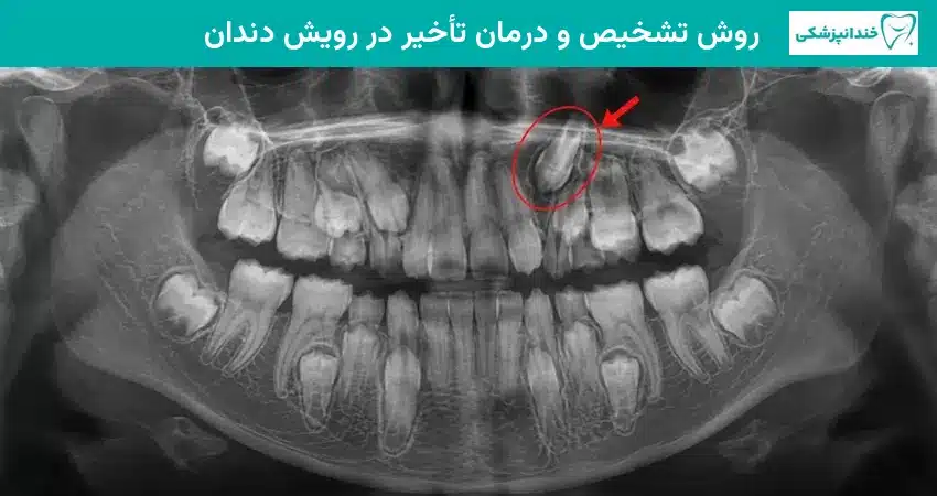 روش تشخیص و درمان تأخیر در رویش دندان