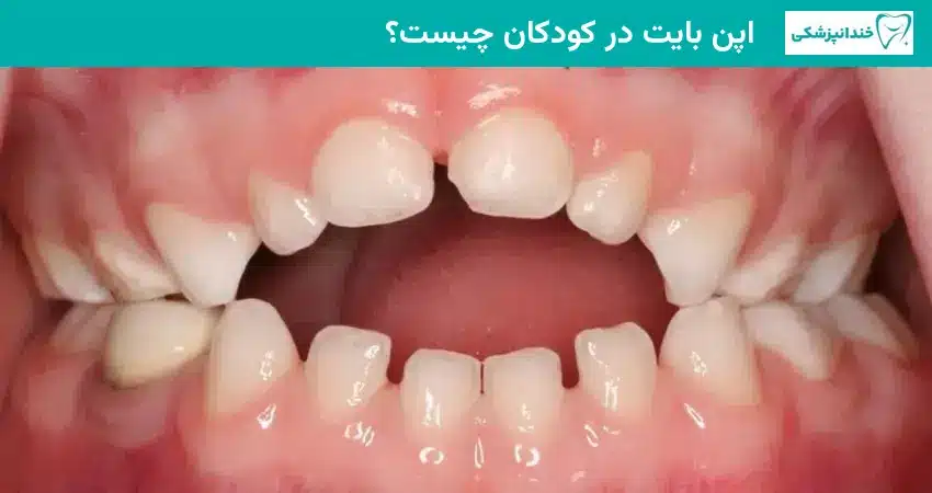 اپن بایت در کودکان چیست؟
