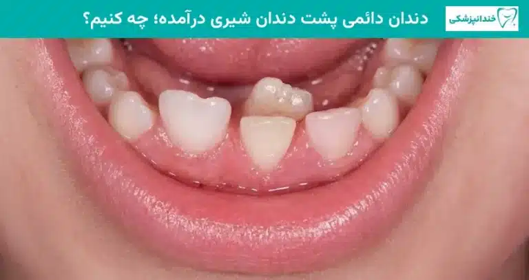 دندان دائمی پشت دندان شیری درآمده؛ چه کنیم؟