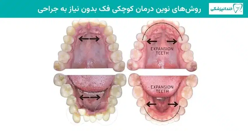 روشهای نوین درمان کوچکی فک بدون نیاز به جراحی