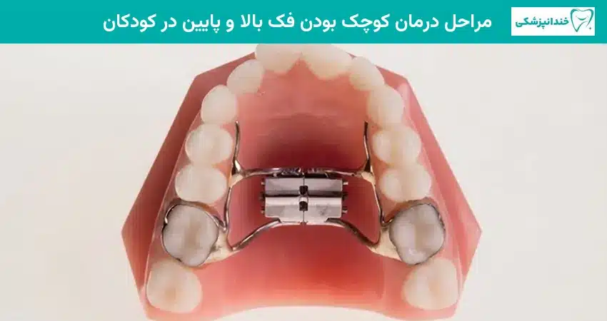 مراحل درمان کوچک بودن فک بالا و پایین در کودکان