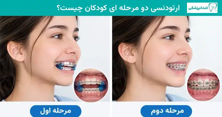 ارتودنسی دو مرحله ای کودکان چیست؟
