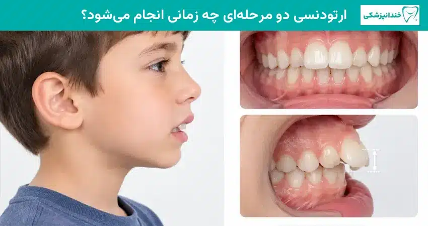 ارتودنسی دو مرحلهای چه زمانی انجام می شود؟