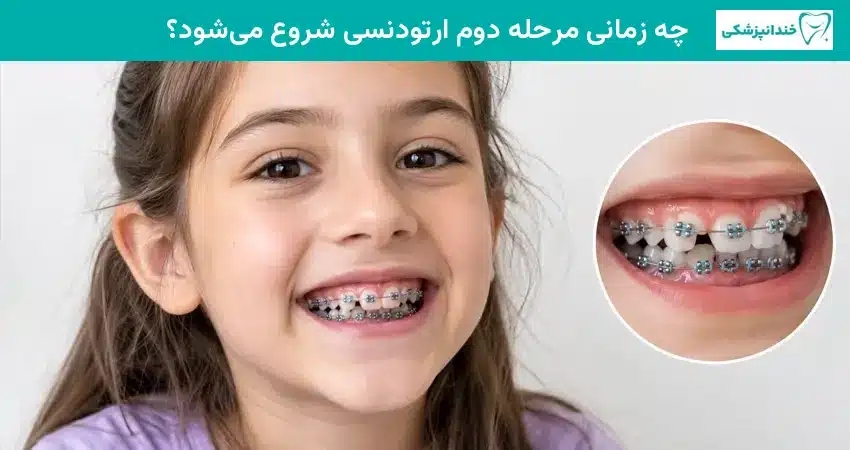 چه زمانی مرحله دوم ارتودنسی شروع می شود؟